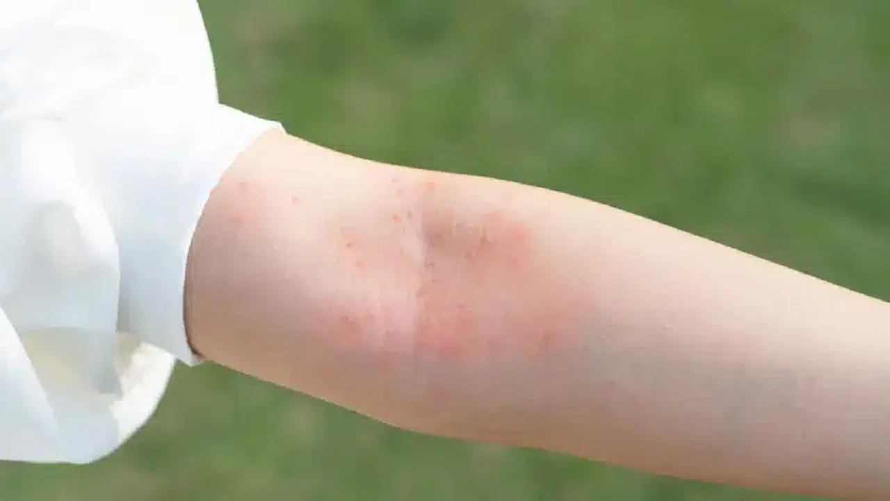 Allergies Demystified: Comprehensive Guide