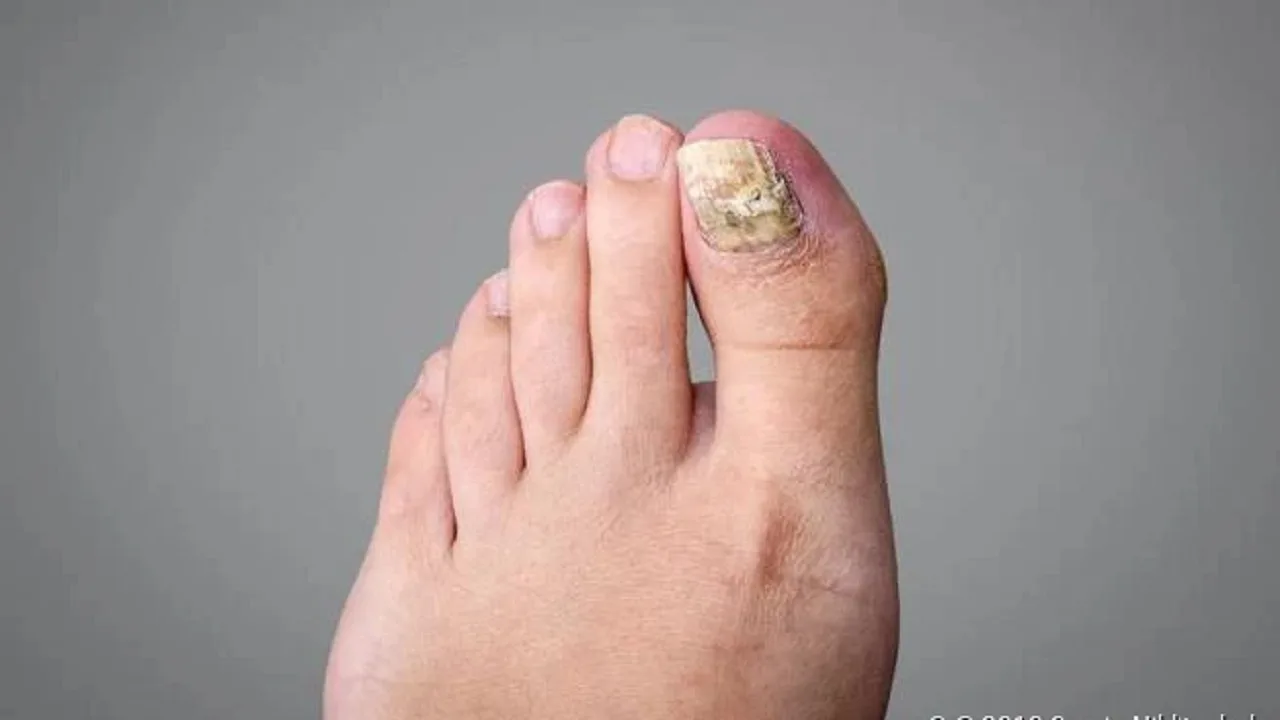 Nail Psoriasis: Understanding the Signs...