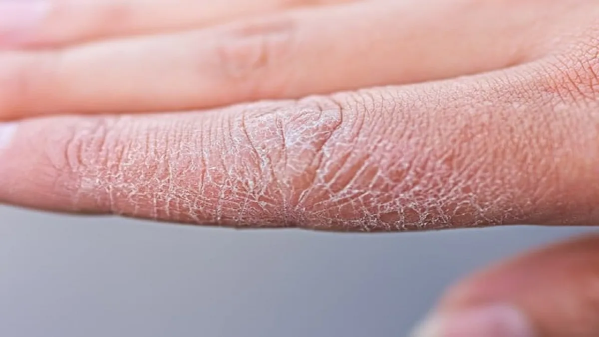 Scaly Skin No More Navigating Life With Psoriasis