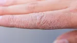 Scaly Skin No More Navigating Life with Psoriasis