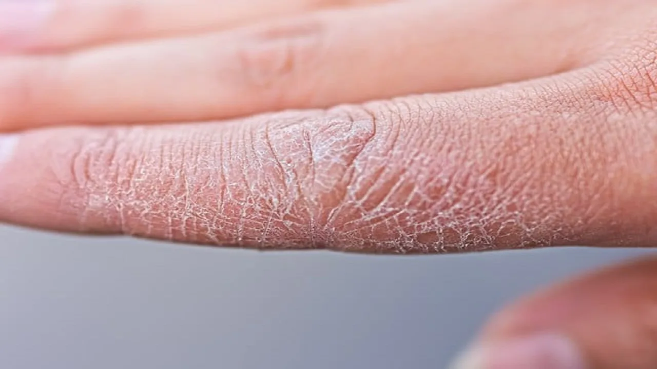 Scaly Skin No More: