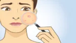 What helps against pimples The most effective tips to get rid of annoying impurities