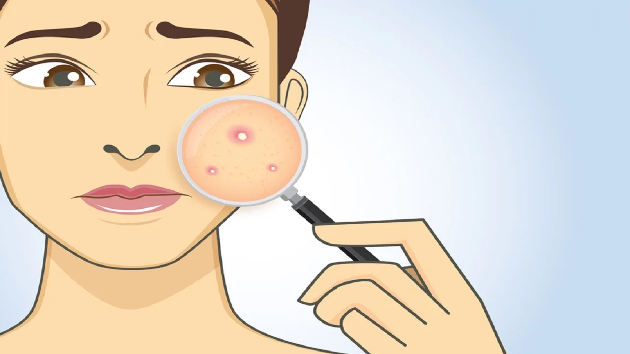 What helps against pimples? The...