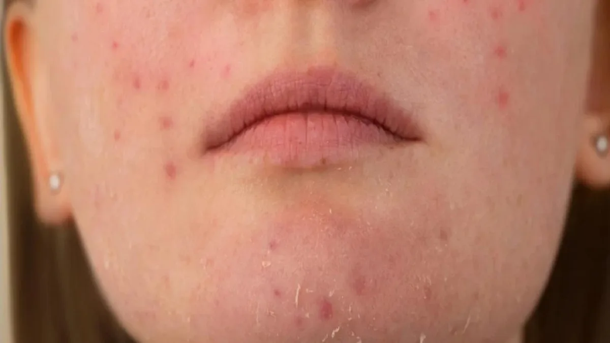 Dry Skin And Blemishes Here's What You Can Do To Treat Them