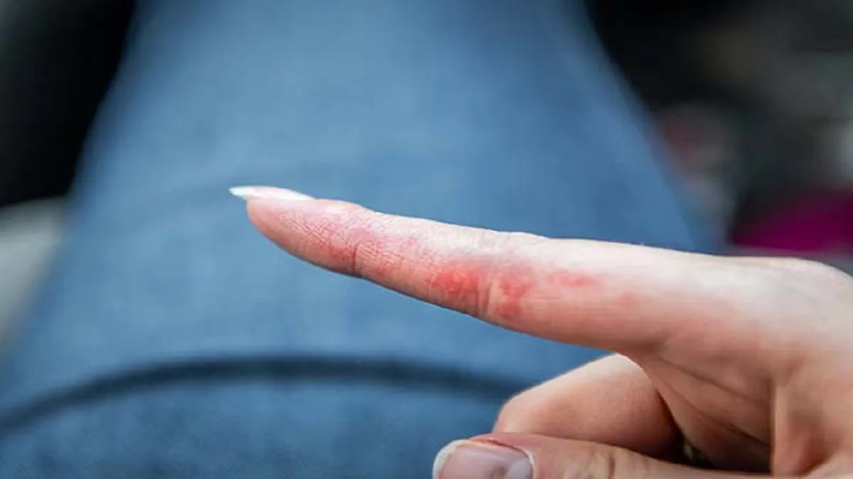 Dry Skin – Symptoms, Causes, Care & Home Remedies