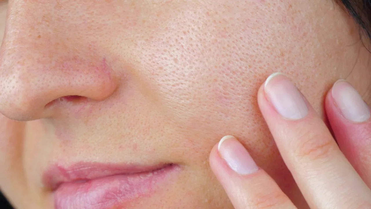 How to Minimize Enlarged Pores...