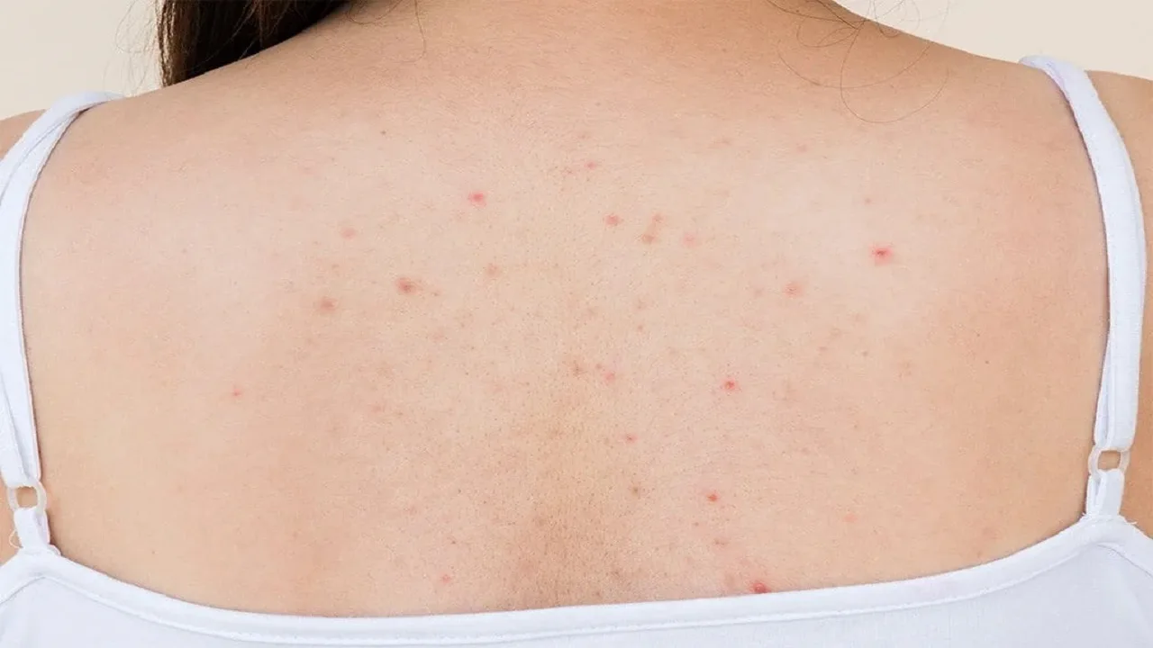 Pimples on the Back: Why...