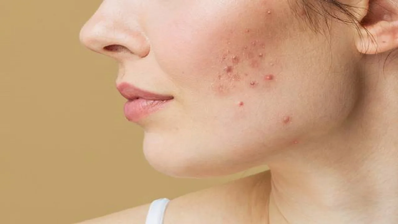 Red Spots and Acne Scars:...