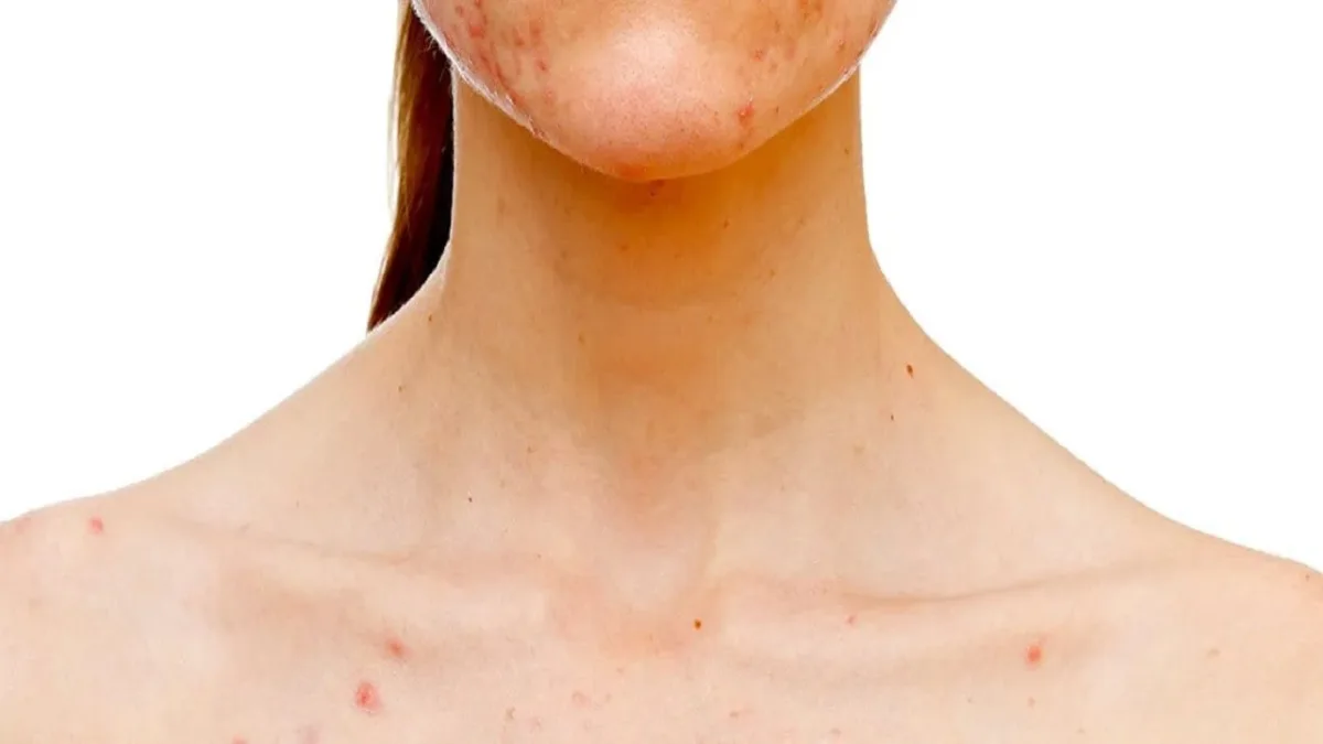 Stress Dermatitis Triggers And How To Care For Your Skin