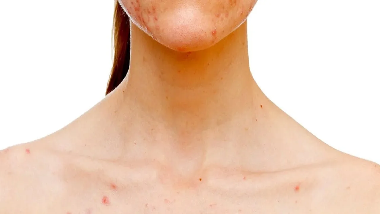 Stress Dermatitis: Triggers and