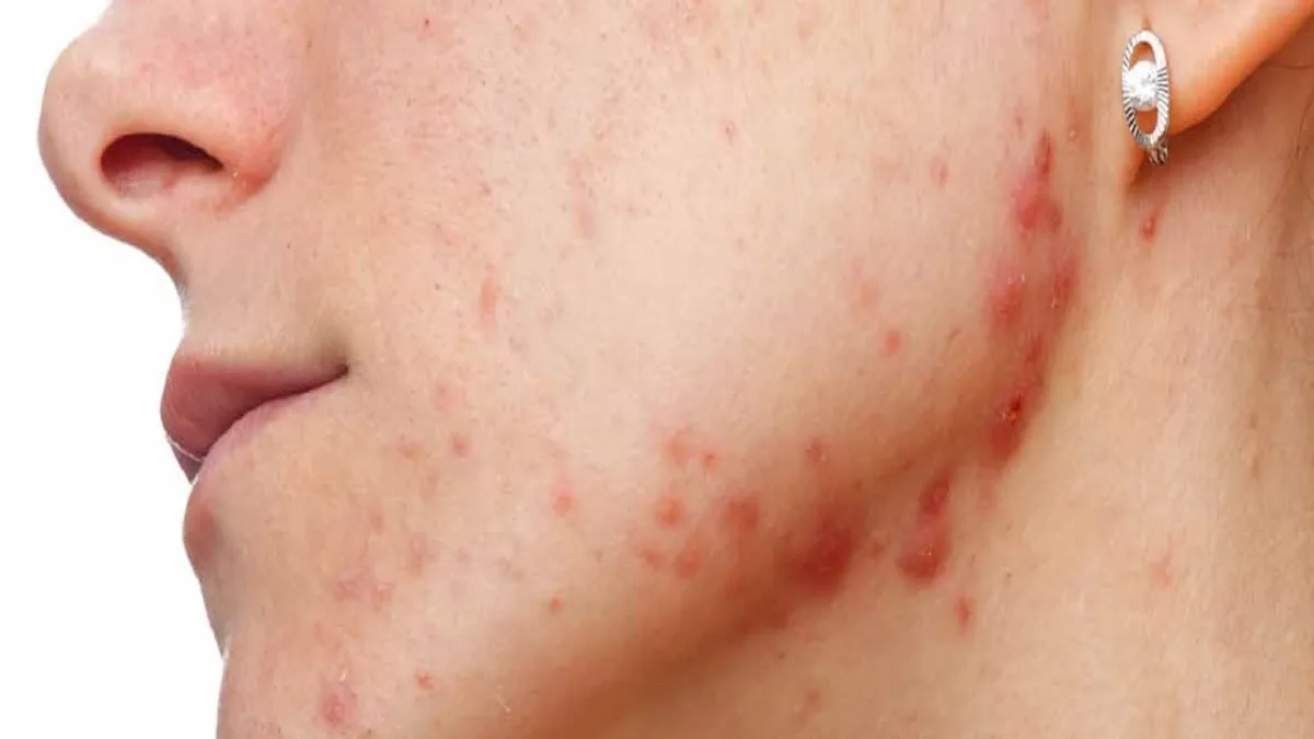 What Is Cystic Acne, Causes And How To Treat It