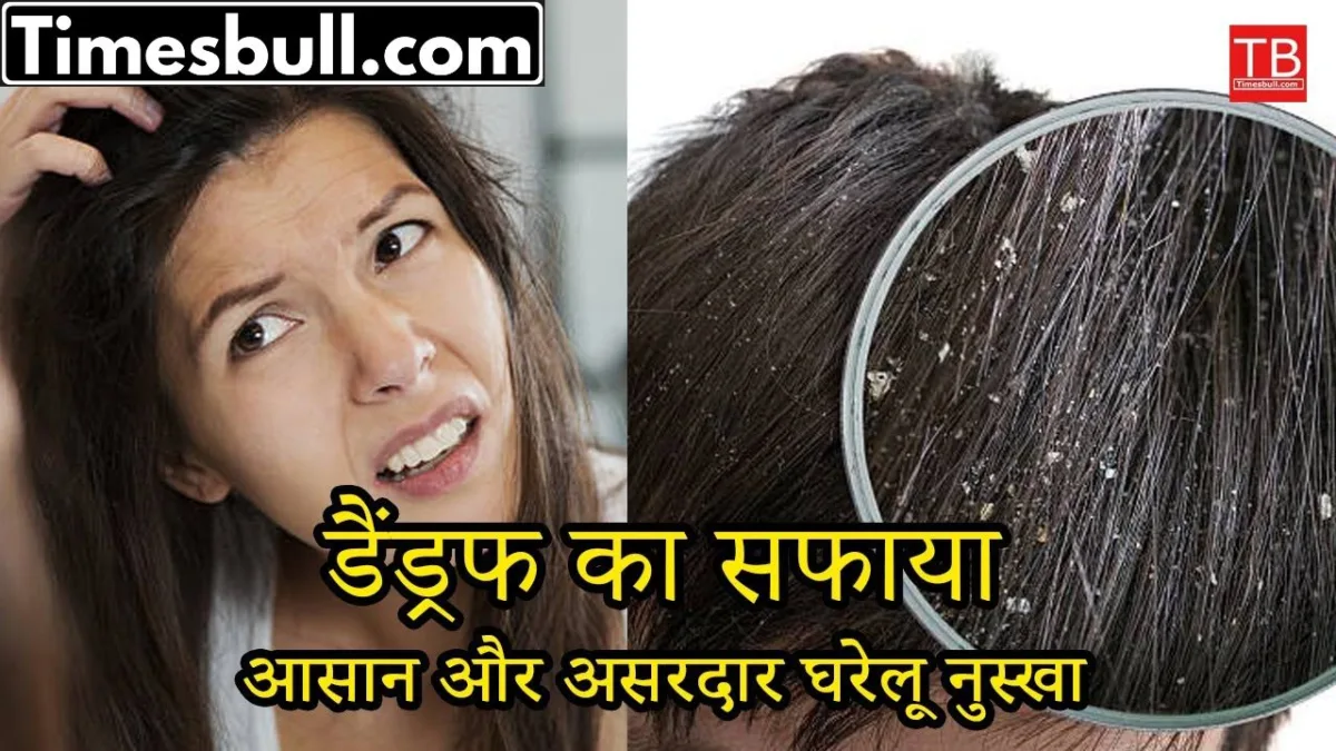 Dandruff