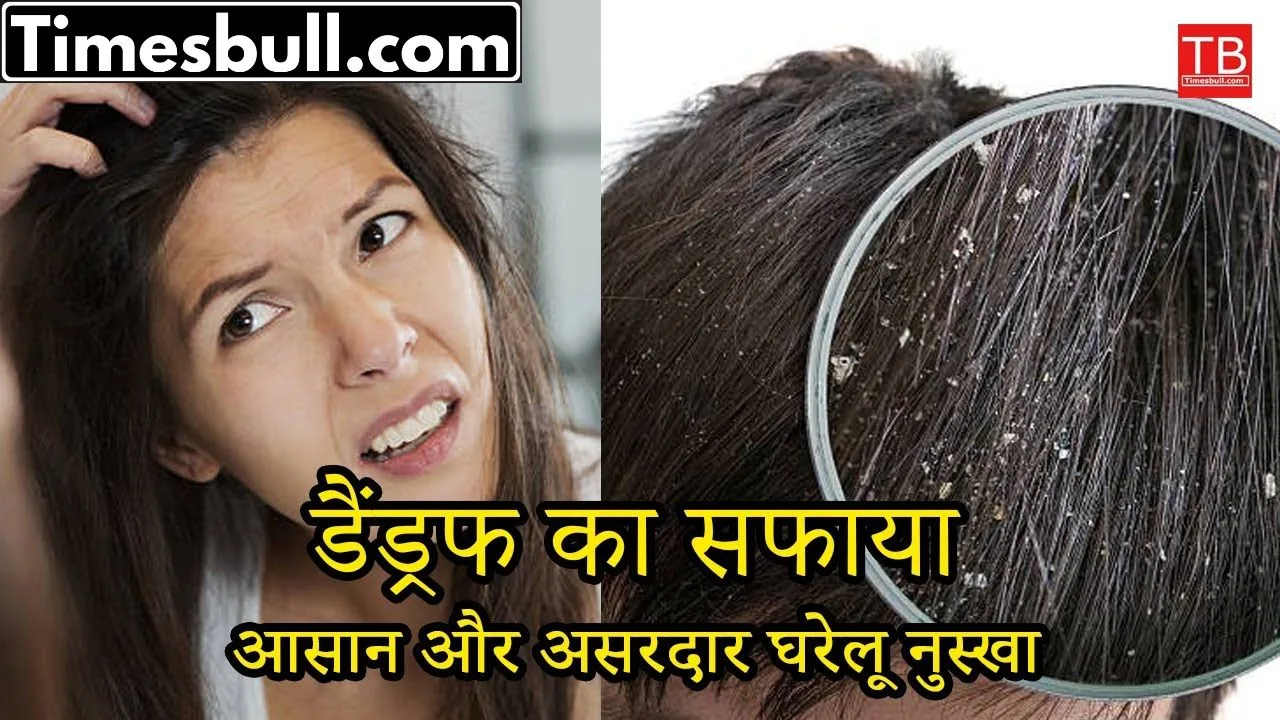 Dandruff treatment at home:
