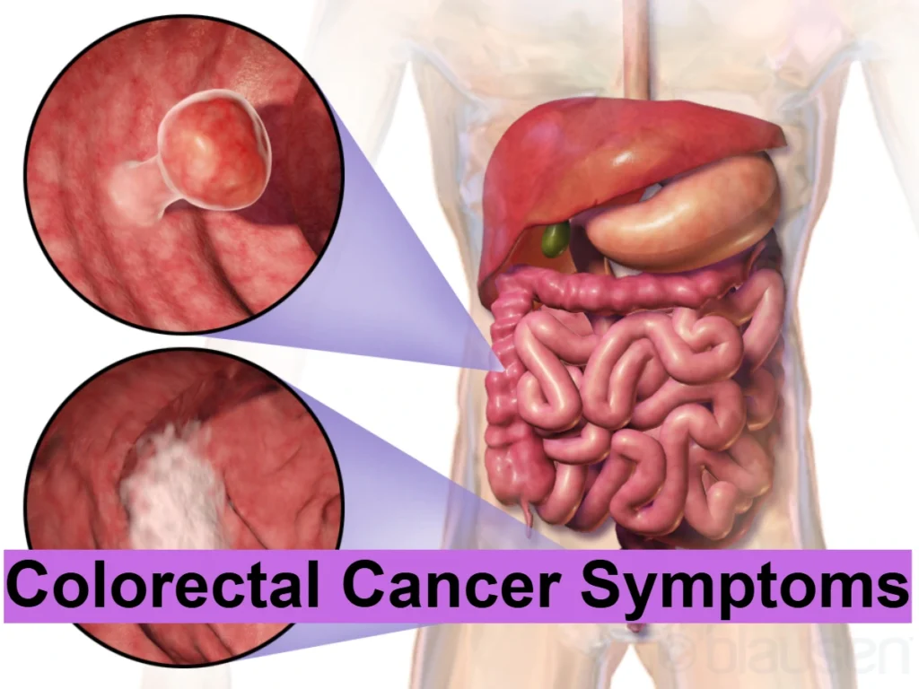 Colorectal Cancer Symptoms