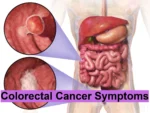Colorectal Cancer Symptoms