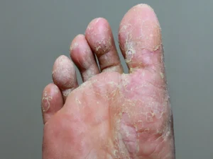 Fungal Infection In Summer: Symptoms, Causes & Treatment