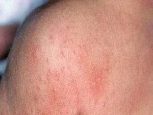 Home Remedies for Ghamoria