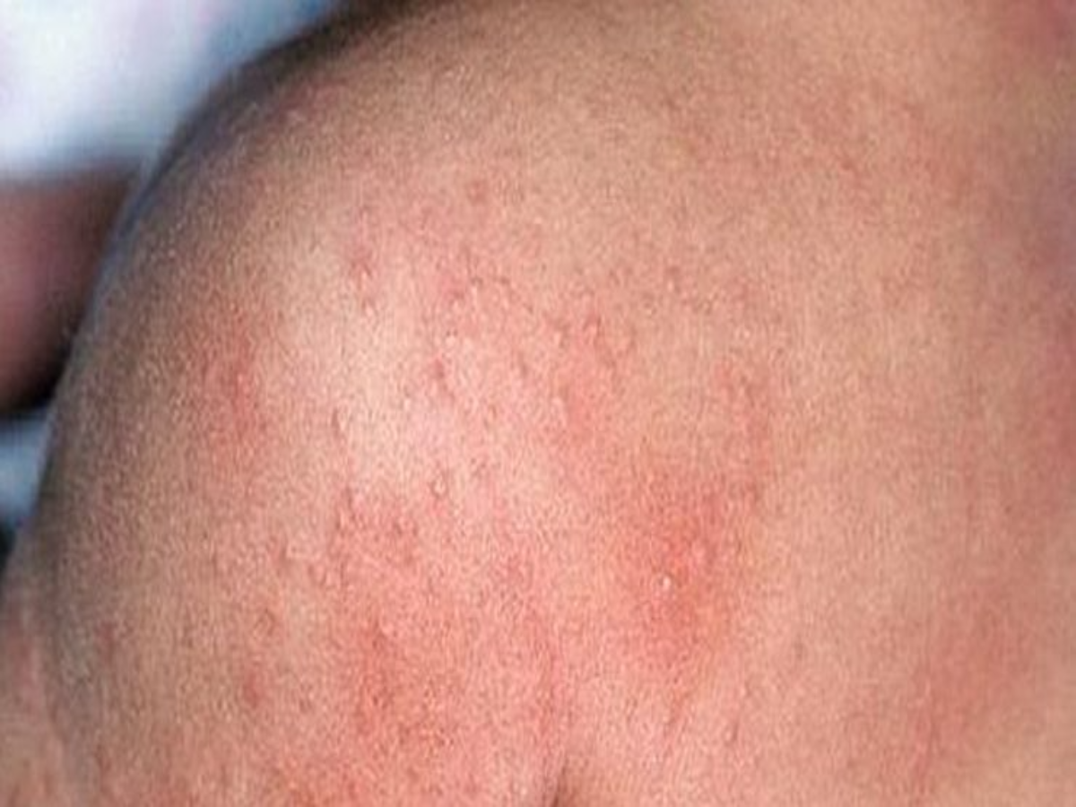 Home Remedies for Ghamoria