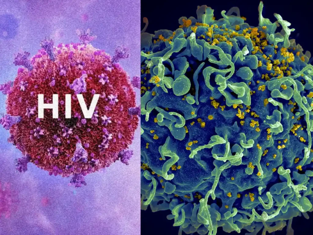 HIV AIDS