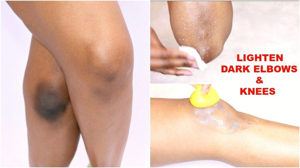 Say Goodbye to Dark Elbows : Easy and Effective Home Remedies