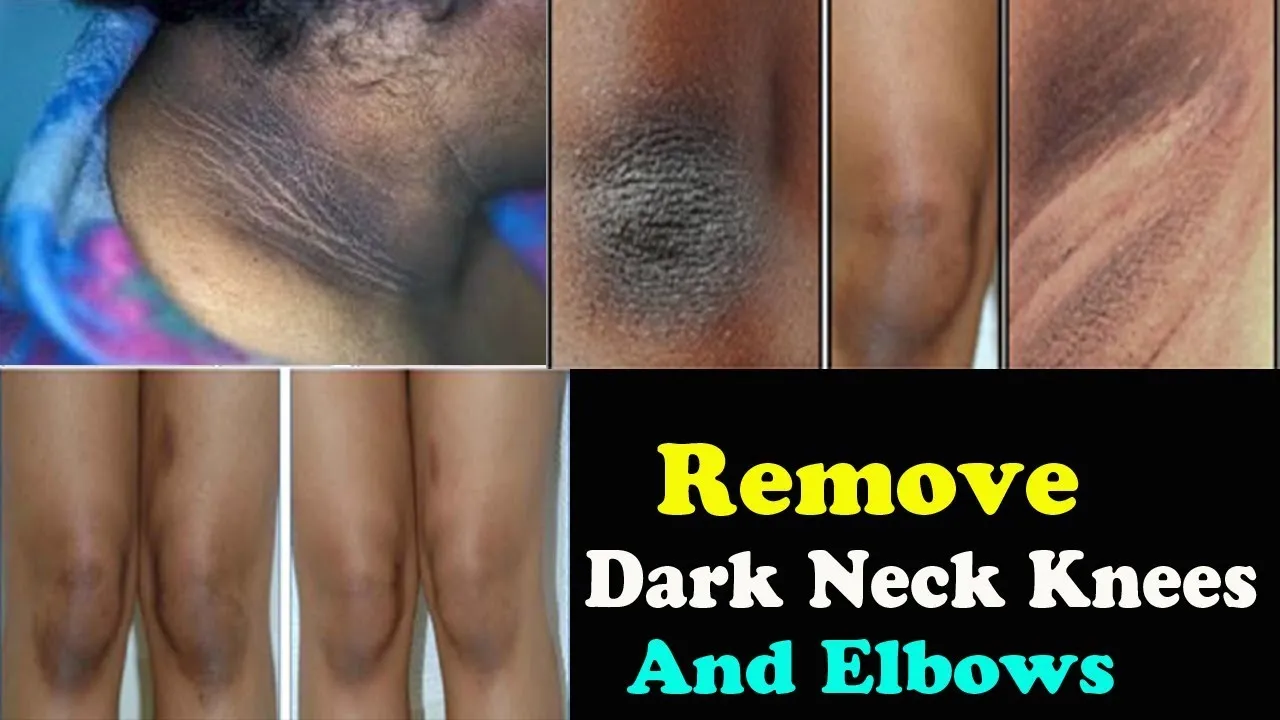  neck Dirt And Dark Elbows Remove Trick
