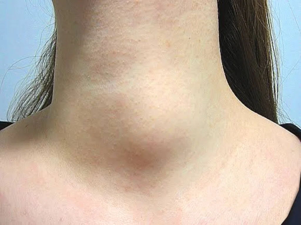 Thyroid nodules