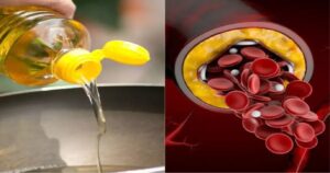 कोलेस्ट्रॉल से छुटकारा पाने के लिए सब्जी में खाएं ये तेल, जल्द दिखेगा असर