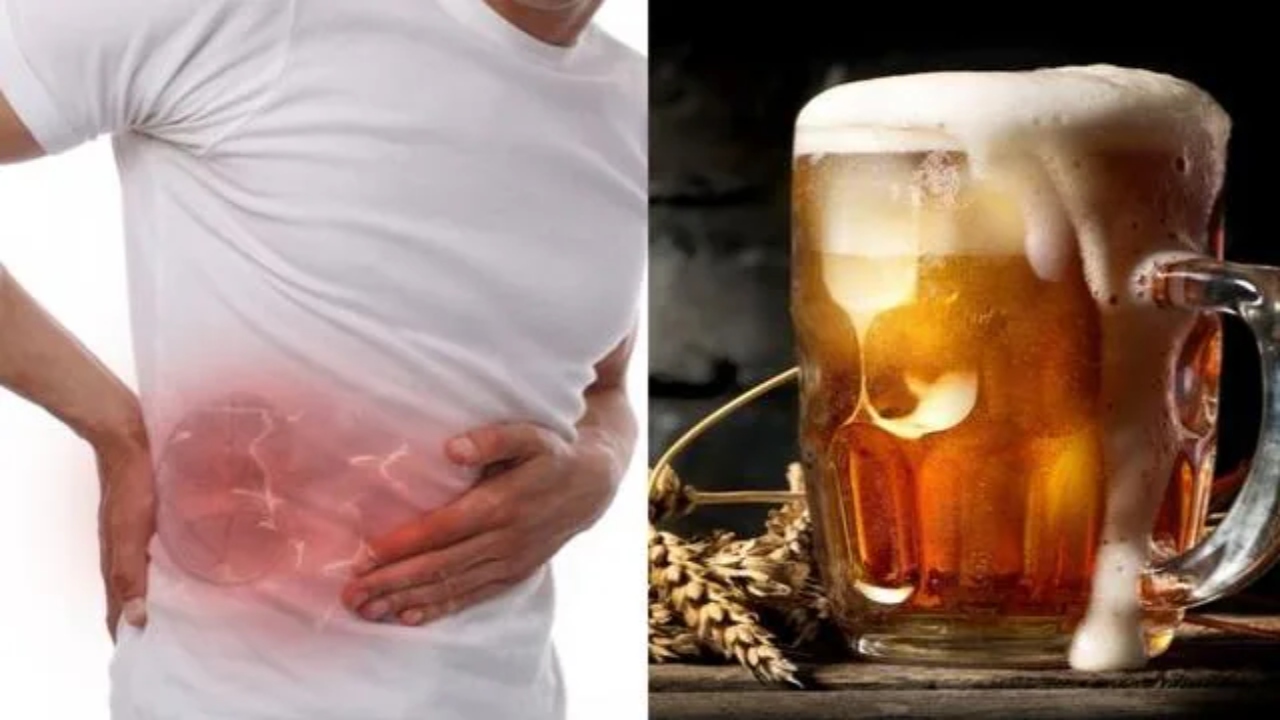 Beer for Kidney Stones